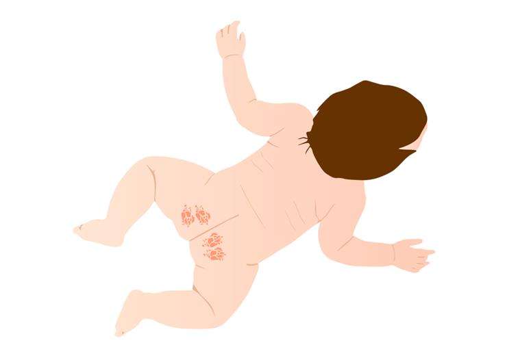 Пеленочный дерматит