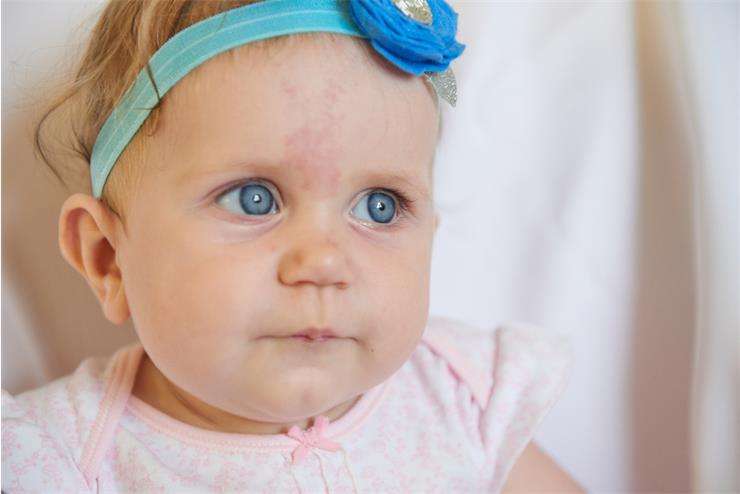 родимое пятно у новорожденного