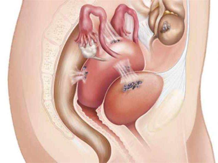 Эндометриоз матки - типичная локализация