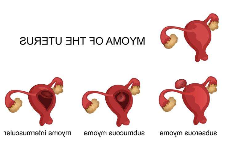 можно ли забеременеть при миоме матки