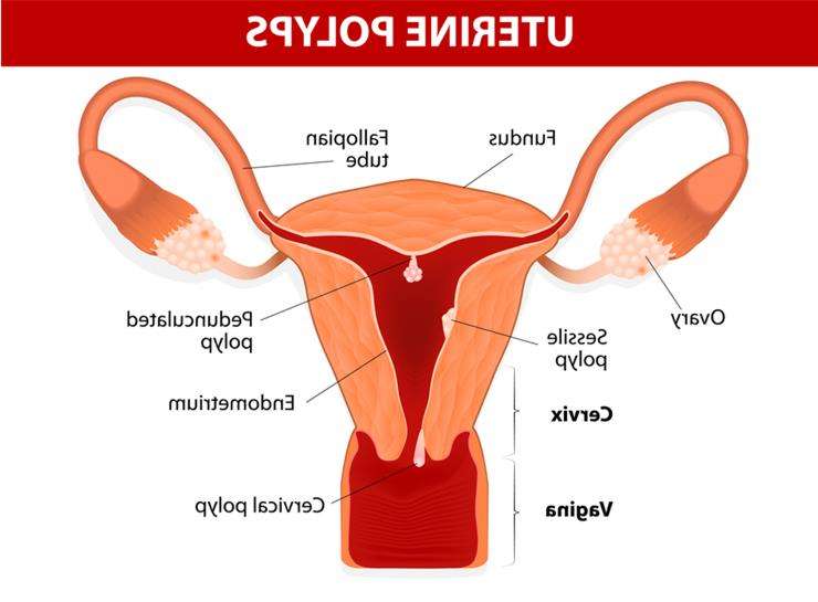 фиброзный полип эндометрия
