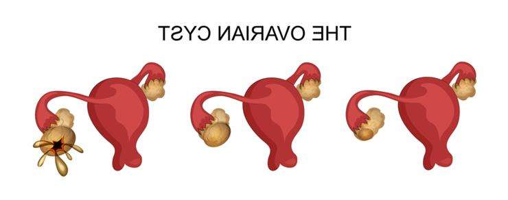 разрыв яичника у женщин