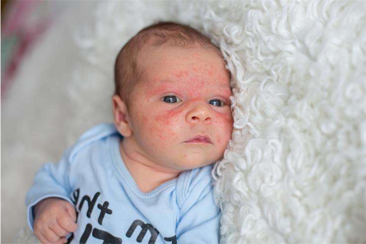 Пузырчатка новорожденных