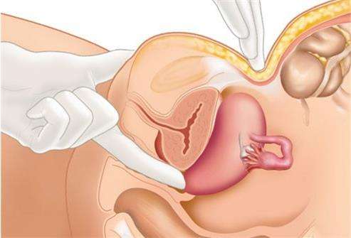 Эндометриоз матки требует тщательного осмотра гинекологом