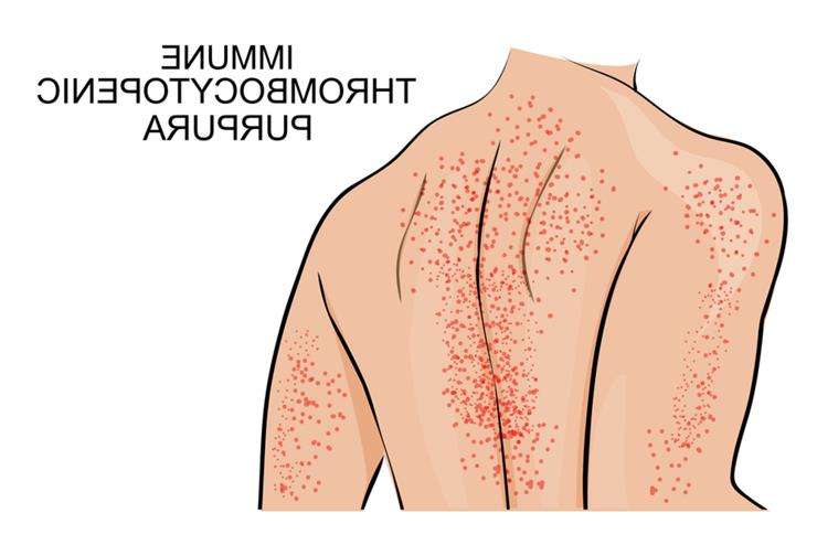 Тромбоцитопения у детей: симптомы и лечение