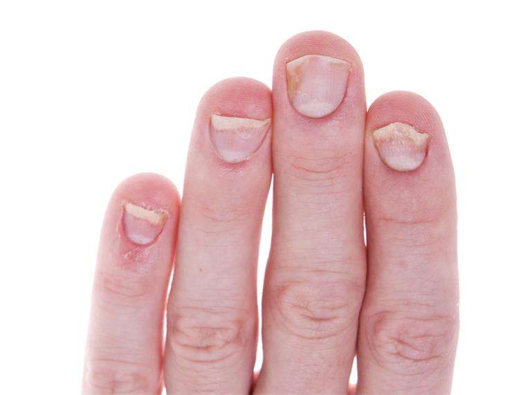 Изменения ногтевой пластины
