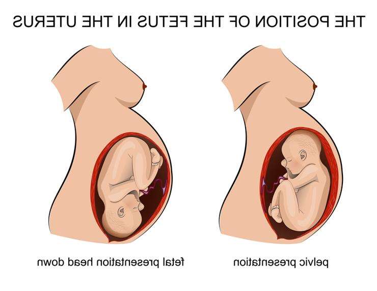 Головное предлежание плода
