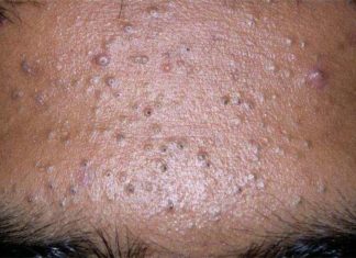 Причини появи і лікування комедонов на обличчі