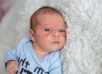 Що таке пухирчатка новонароджених