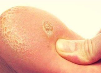 Догляд за пятами ніг в домашніх умовах